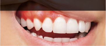 periodoncia-gredy-dental